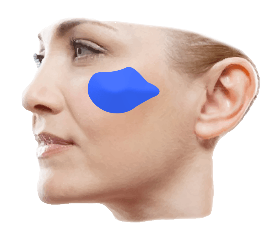 cheek implant graphic