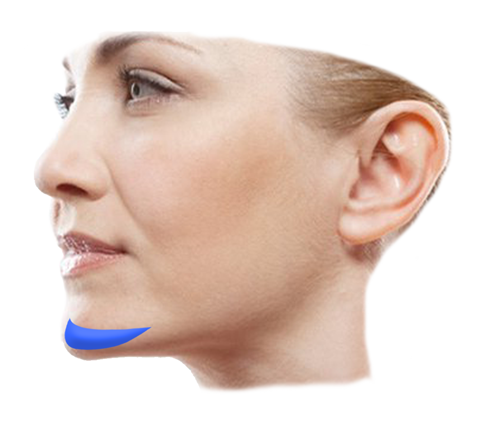 chin implant graphic