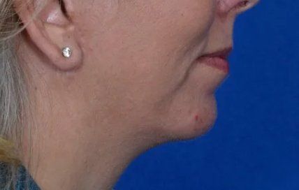 chin implant after