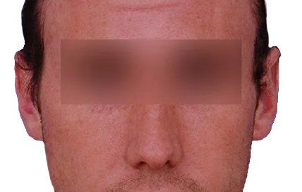after otoplasty