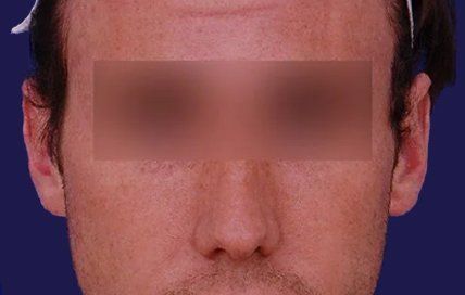 male earlobe surgery after
