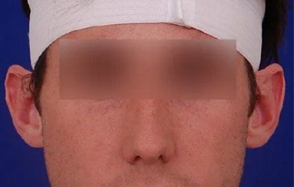 male earlobe surgery before