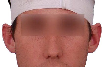 before otoplasty