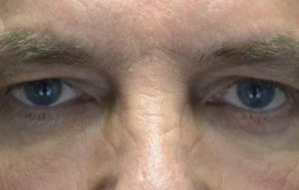 Upper eyelid surgery before and after Milwaukee patient