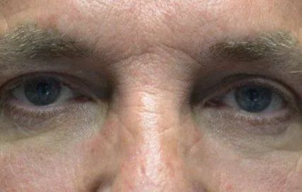 Upper eyelid surgery before and after Milwaukee patient