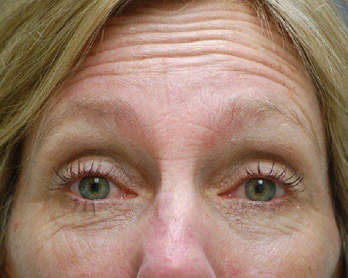 before botox on forehead lines