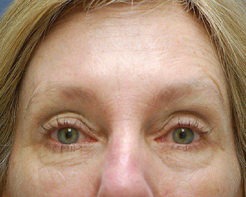 after botox on forehead lines