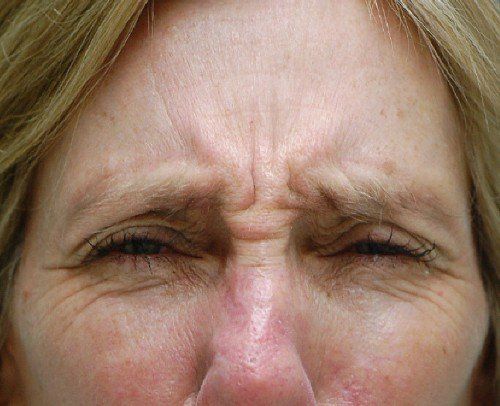 bunny lines before botox