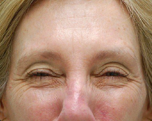 frown lines after botox