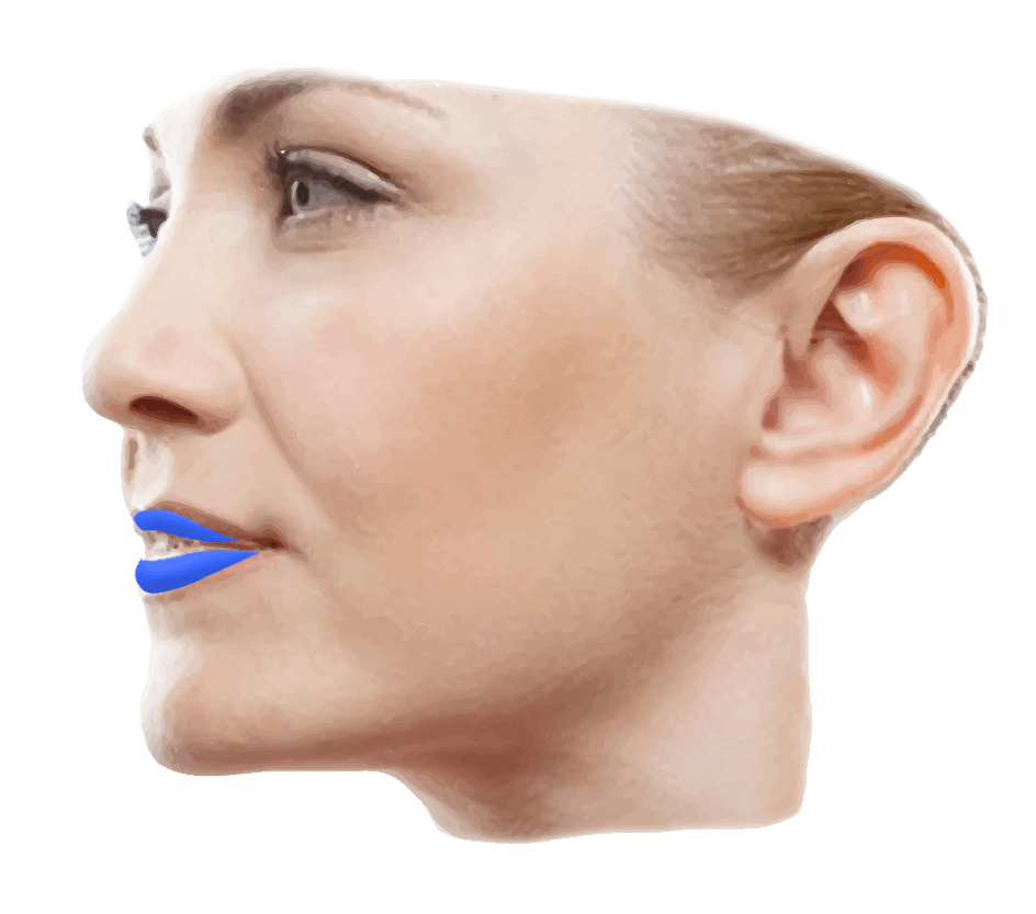 lip implant graphic
