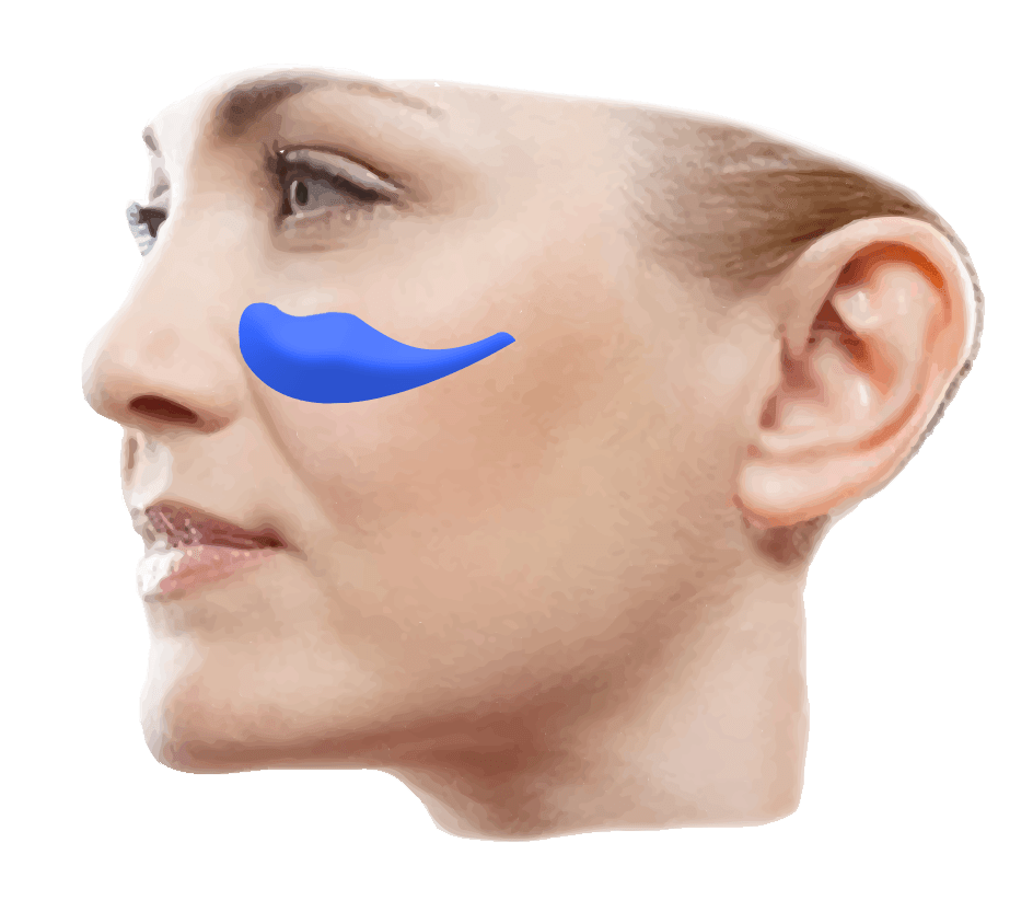midface implant graphic