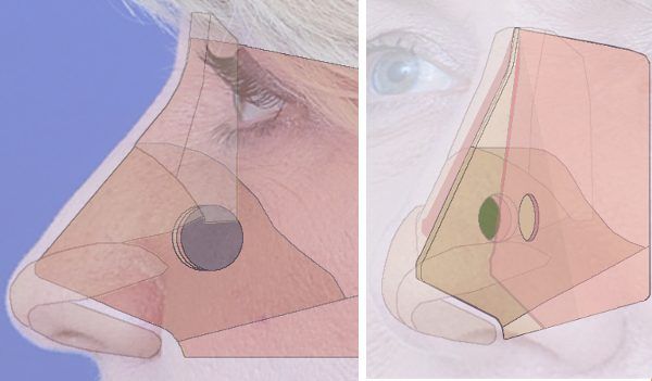 septoplasty graphic