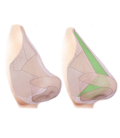 infographic of nose before and after rhinoplasty