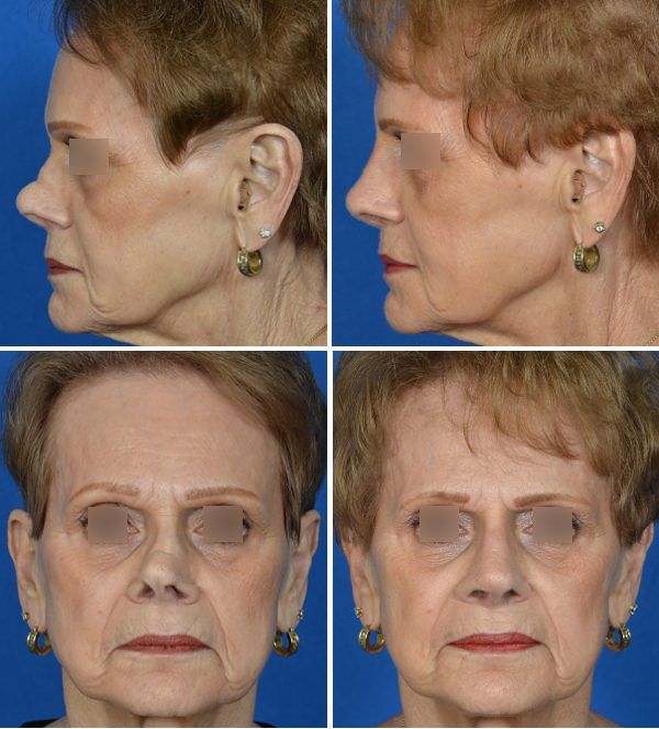 before and after photos of saddle nose rhinoplasty