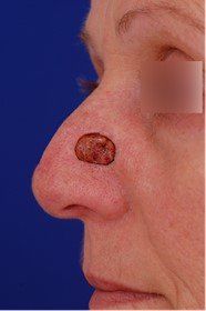 skin cancer on nose