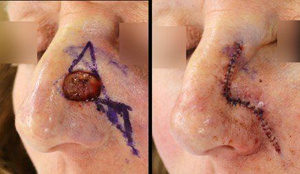 skin cancer on nose