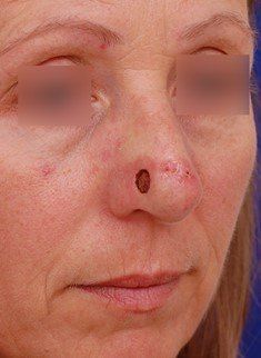 skin cancer on nose