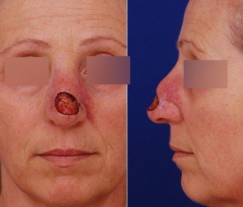 skin cancer on nose