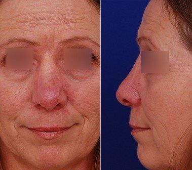 Post-skin cancer surgery results from Dr. Anand Patel