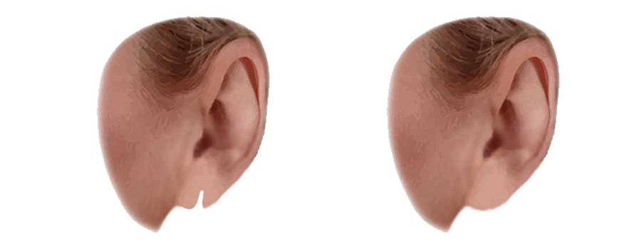 graphic of earlobe repair surgery