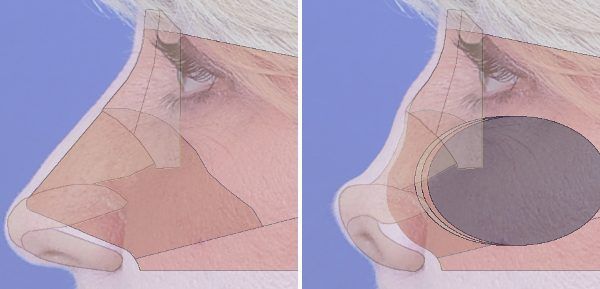 septoplasty graphic