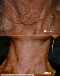Younger skin after treatment