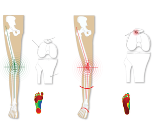 Overpronation Comparison — Diamond, IL — Diamond Therapy Center Overpronation Comparison — Diamond, IL — Diamond Therapy Center