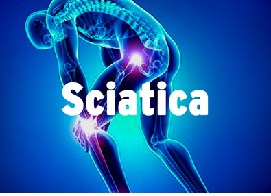 Sciatica Pain Visual — Diamond, IL — Diamond Therapy Center Sciatica Pain Visual — Diamond, IL — Diamond Therapy Center