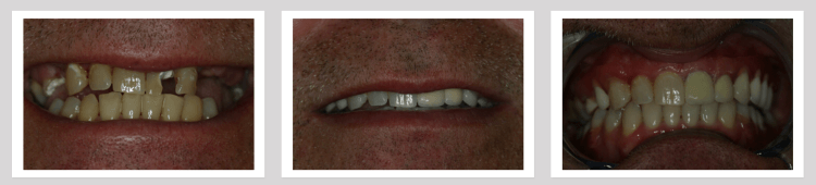 Crowns & Bridges Before and After - Crown Point Dental