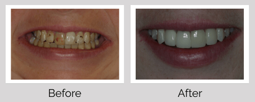 Crowns & Bridges Before and After - Crown Point Dental