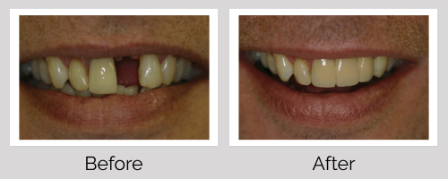 Crowns & Bridges Before and After - Crown Point Dental