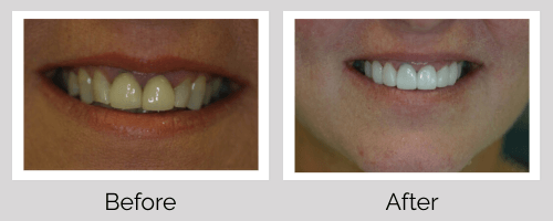 Crowns & Bridges Before and After - Crown Point Dental