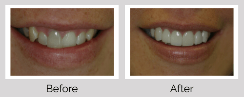 Crowns & Bridges Before and After - Crown Point Dental
