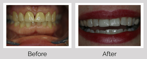 Crowns & Bridges Before and After - Crown Point Dental