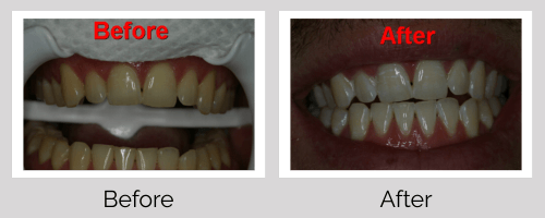 Crowns & Bridges Before and After - Crown Point Dental