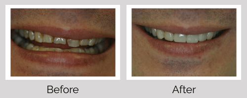 Crowns & Bridges Before and After - Crown Point Dental