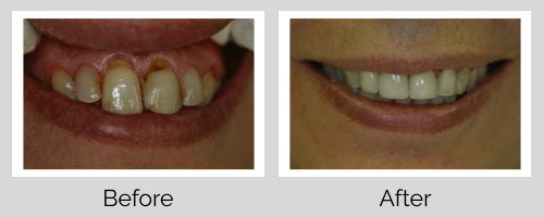 Crowns & Bridges Before and After - Crown Point Dental