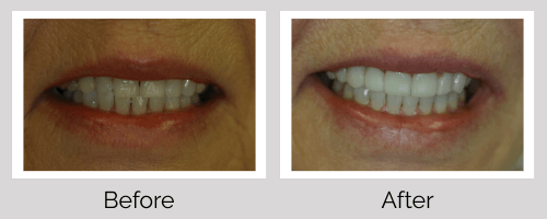Crowns & Bridges Before and After - Crown Point Dental
