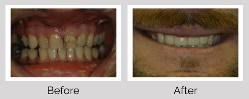 Crowns & Bridges Before and After - Crown Point Dental