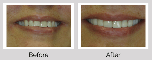 Crowns & Bridges Before and After - Crown Point Dental