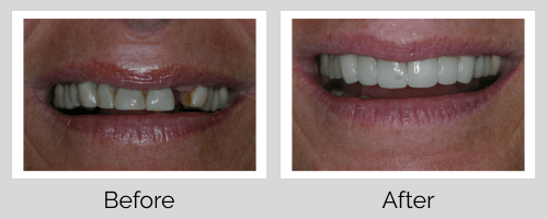 Crowns & Bridges Before and After - Crown Point Dental