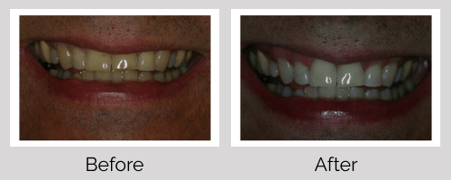 Crowns & Bridges Before and After - Crown Point Dental