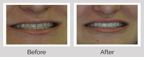 Crowns & Bridges Before and After - Crown Point Dental