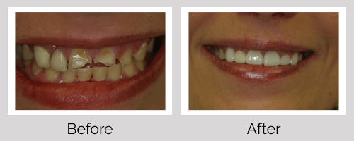 Crowns & Bridges Before and After - Crown Point Dental