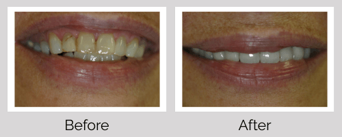 Crowns & Bridges Before and After - Crown Point Dental