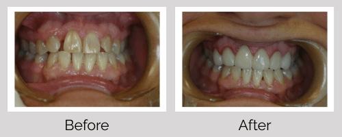 Crowns & Bridges Before and After - Crown Point Dental