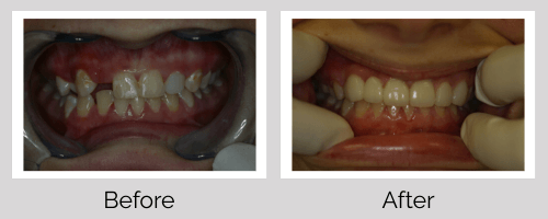 Crowns & Bridges Before and After - Crown Point Dental