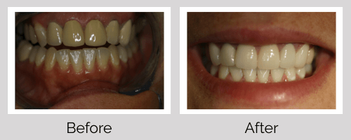 Crowns & Bridges Before and After - Crown Point Dental