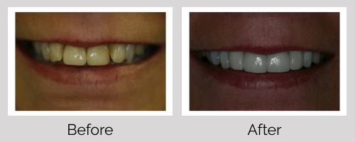 Crowns & Bridges Before and After - Crown Point Dental