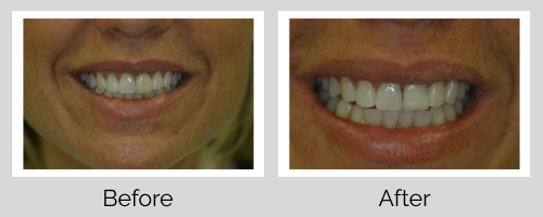 Crowns & Bridges Before and After - Crown Point Dental